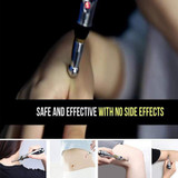 ReliefWand™ Acupuncture Pen