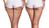 Anti-Cellulite Skin Tightening Massager