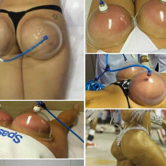 Fatten Buttocks Back Cupping Breast Massager Chest Hips Trainer Butt Bil Lifting Colombien Sharpening Hijama Suction Cups Vacuum