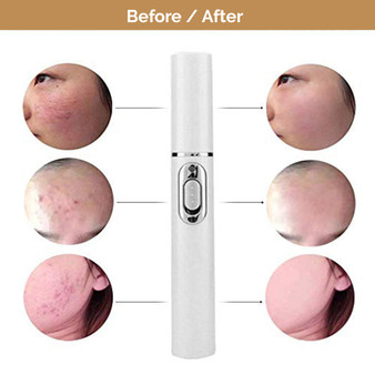 Laser Acne Remover
