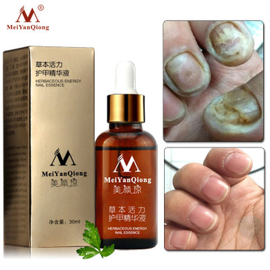 MeiYanQiong Fungal Nail Treatment Feet Care Essence Nail Foot Whitening Toe Nail Fungus Removal Gel Anti Infection Paronychia