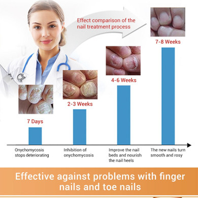 Fungal Nail Healthy Treatment  Repair Serum Anti Infection
