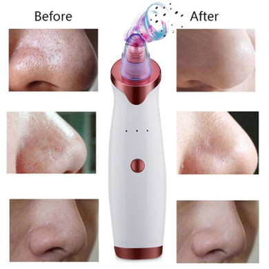 Remove Blackheads Vacuum Pore Cleaner Pro