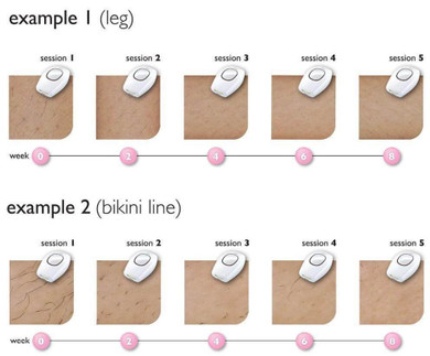 Hair-Off™ IPL Hair Removal System
