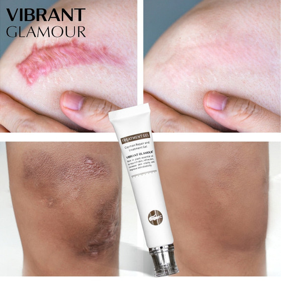 VIBRANT GLAMOUR Repair Scar cream Removal Acne Scars Stretch Marks CreamSurgical scar Burn  For Body Pigmentation Corrector care