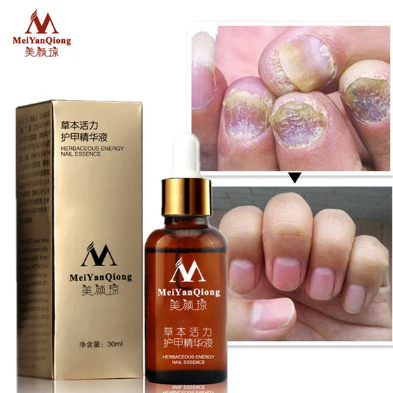 Fungal Nail Treatment Essence Nail and Foot Whitening Toe Nail Fungus Removal Feet Nail Care Essential oil