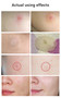Invisible Acne Stickers