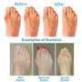 Bunion Correction Orthopedic Sandal