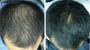 GrowCap by Hairocracy LLLT Hair Growth Laser Caps