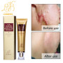 Lanbena Acne Scar Removal