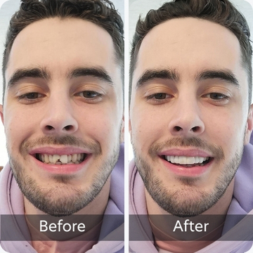 Chipped Teeth teeth
