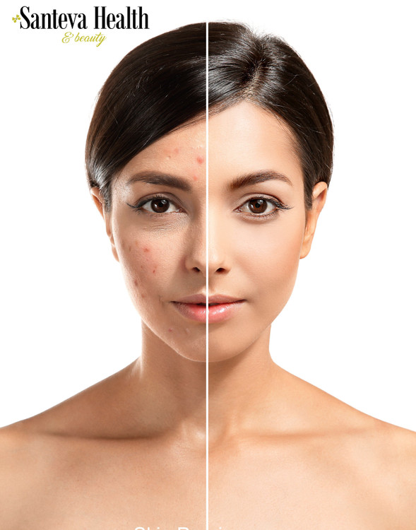 Skin purging? Why is it happening and how to stop it. Skin purging? Why is it happening and how to stop it.