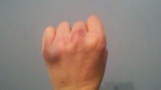 knuckle-injuries-efbvu4ib.jpg