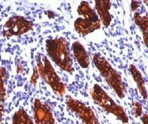 Anti-Thyroglobulin Antibody