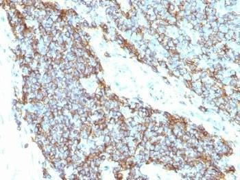 Anti-CD99 Antibody Cocktail