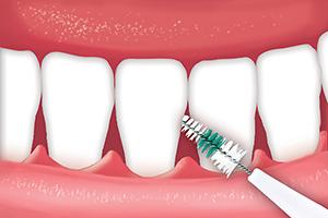 how to use interdental brushes