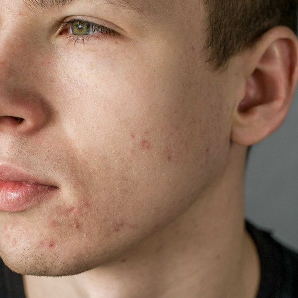 Derma Check Acne Uomo
