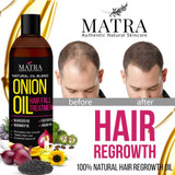 Onion Hair Growth Oil with Blackseed Oil, Castor Oil & Argan Oil |By Matra | 3.88 Oz | 0.24 lbs | SU-TQ-MAY20