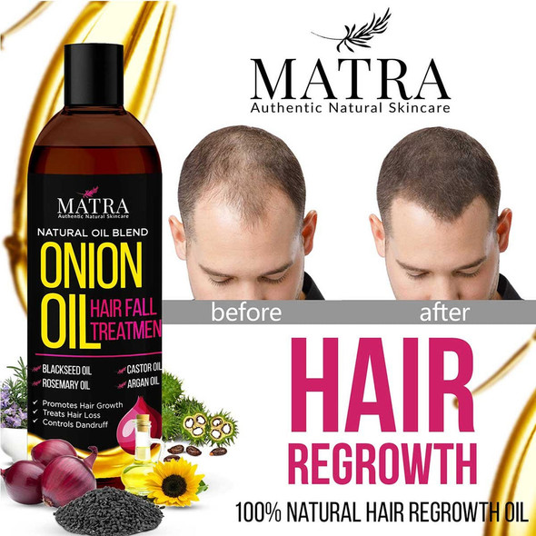 Onion Hair Growth Oil with Blackseed Oil, Castor Oil & Argan Oil |By Matra | 3.88 Oz | 0.24 lbs | SU-TQ-MAY20