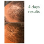 Customer's 4 days results with RejuvenX + Micro-needling Regrowth Booster