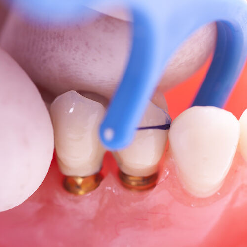 SpotIt Crown and Bridge Contact Finder Assorted Handles, Blue, 18/Pkg.