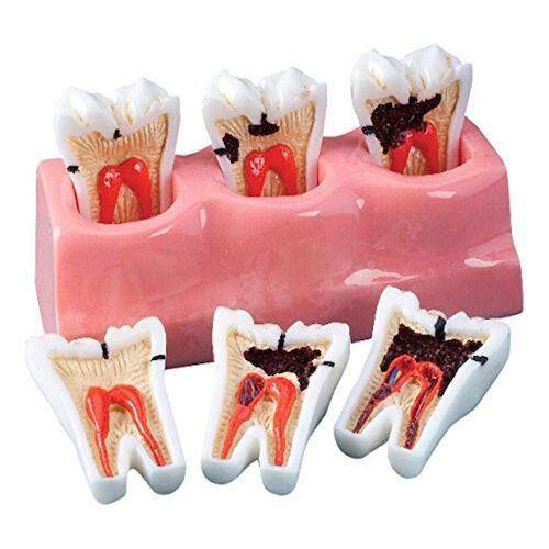 Demonstration Models Caries Progression Model, 5 1/2" Long