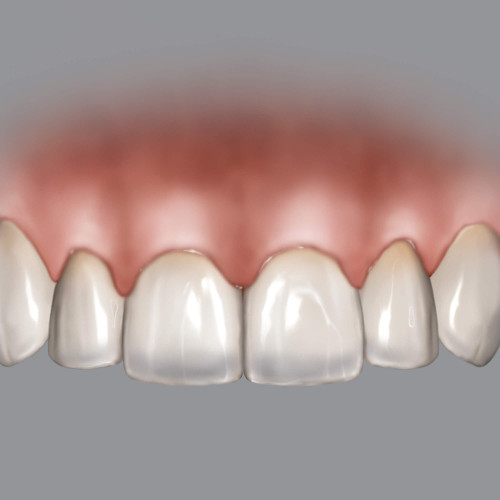 HuFriedy, BLPG Refill for Crown Lengthening Gauge, BLPGREF