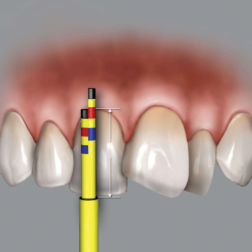 HuFriedy, In-Line Refill for Proportion Gauge, INLINEREF