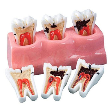 Demonstration Models Caries Progression Model, 5 1/2