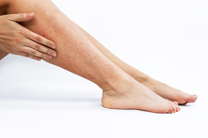 POST WAXING CARE TIPS TO REMOVE SKIN RED BUMPS