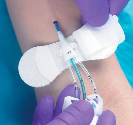 Securement, Catheter/picc Grip-lok Med (100/bx) Bx - 100