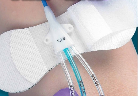 Device, Securement Foley Catheter Grip-lok Sm (100/bx) Bx - 100