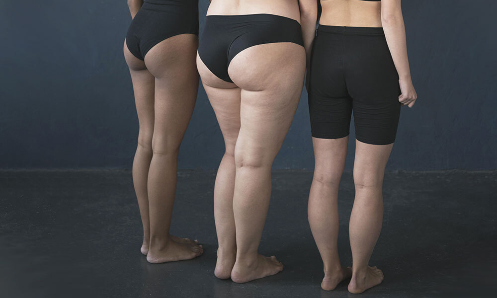 Expertos en Lipedema en Espacio de Salud Madrid