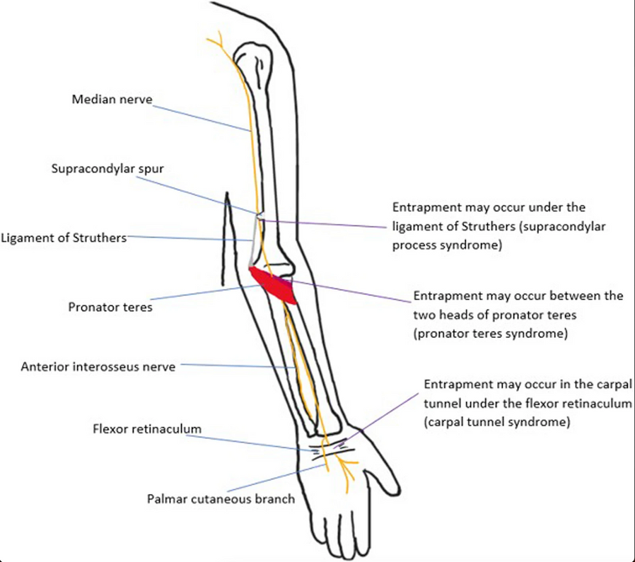 Understanding Carpal Tunnel Syndrome: Prevention and Treatment