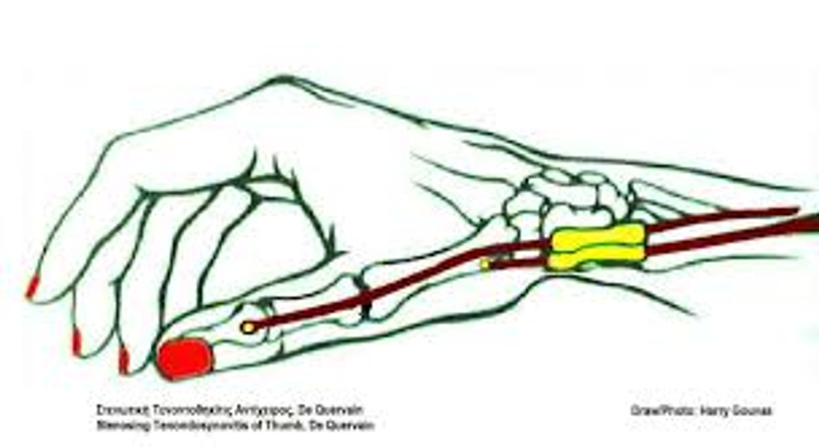 Understanding De Quervain’s Tenosynovitis: Prevention and Treatment Strategies