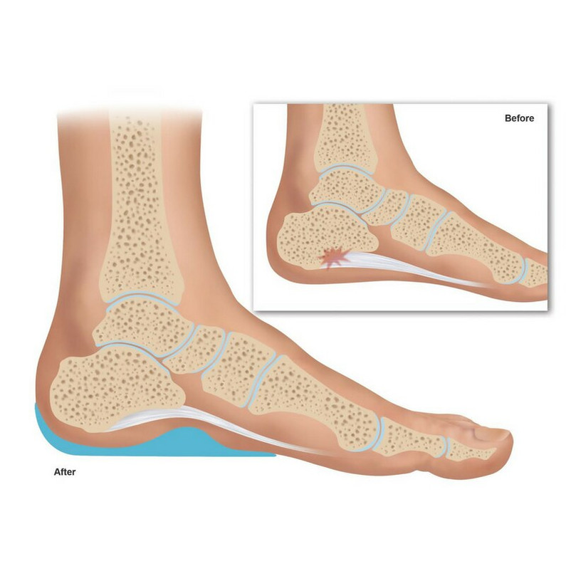 Plantar Fasciitis Therapy Treatments