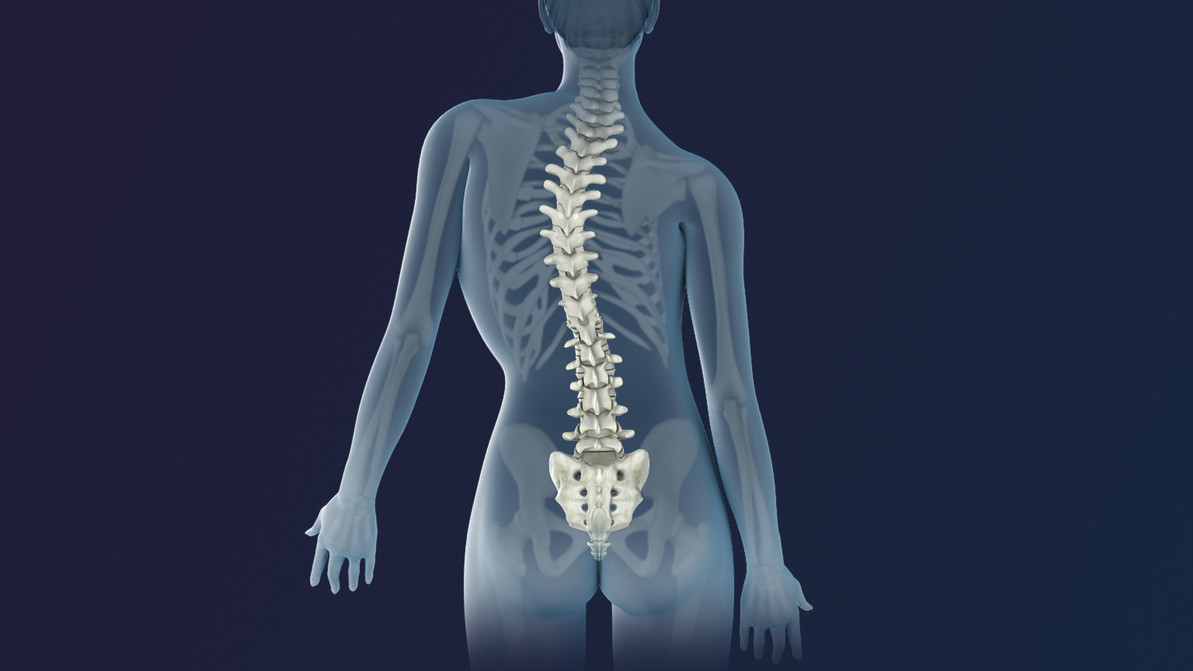 What is Scoliosis?