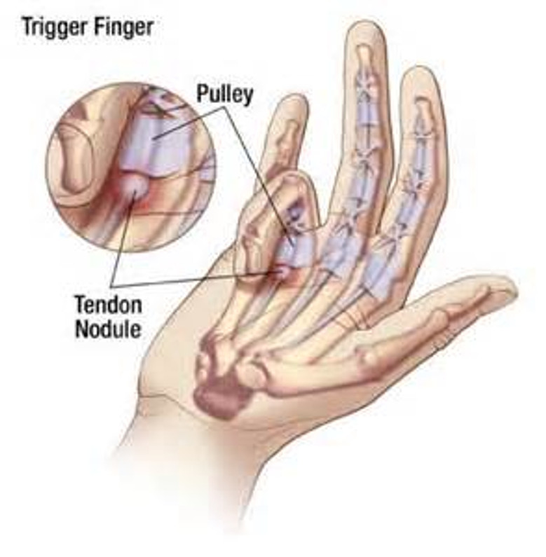 Trigger Finger Prevention and Treatment