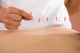 What Is Dry Needling? A Modern Approach to Pain Relief and Muscle Recovery