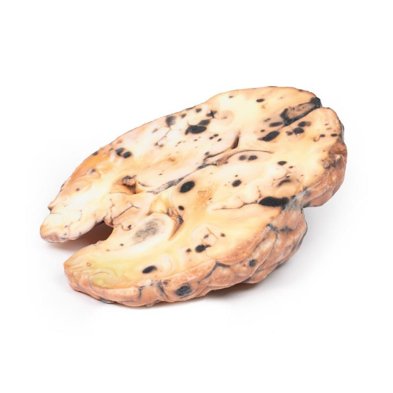 3D Printed Metastatic Melanoma