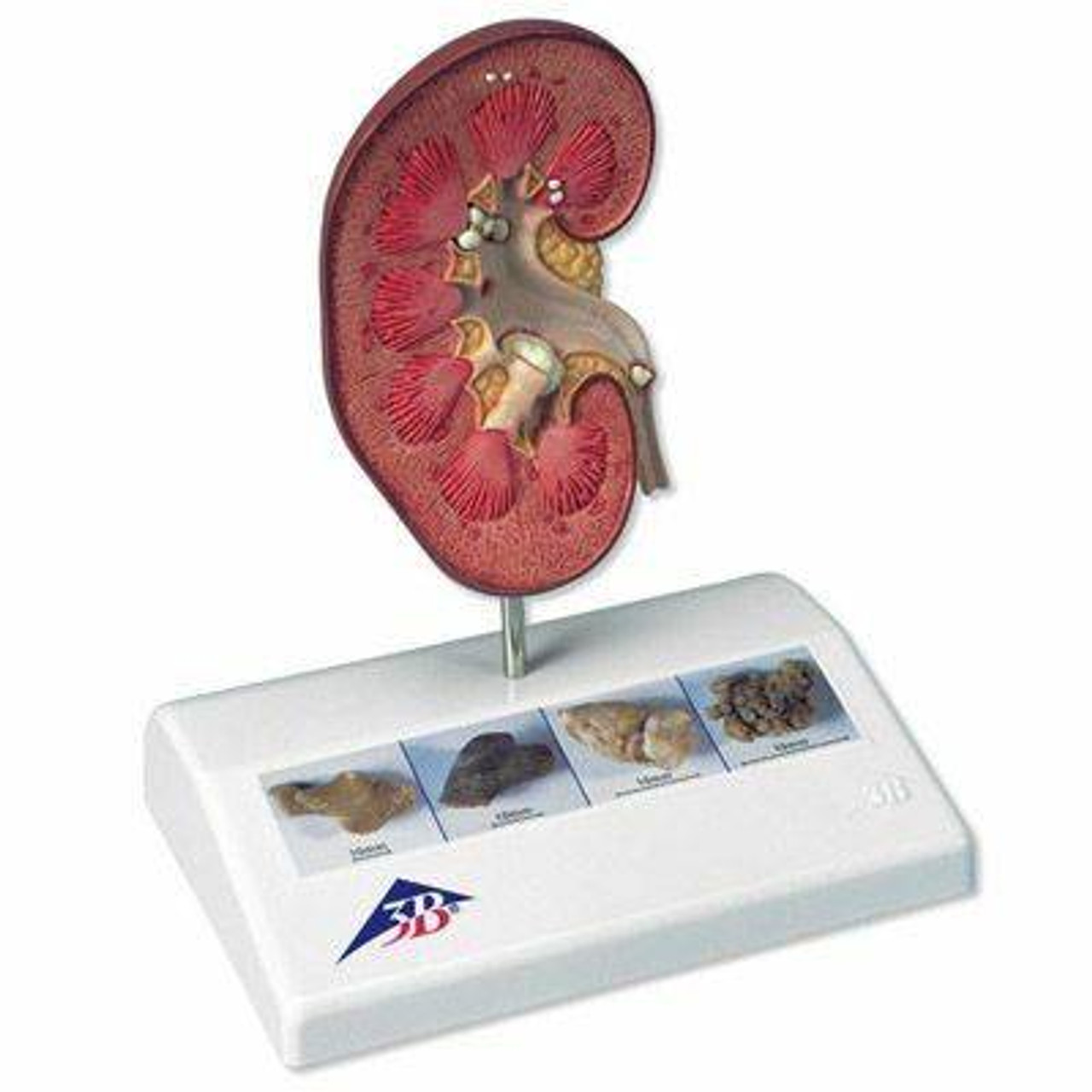 Kidney Stone Anatomy Model
