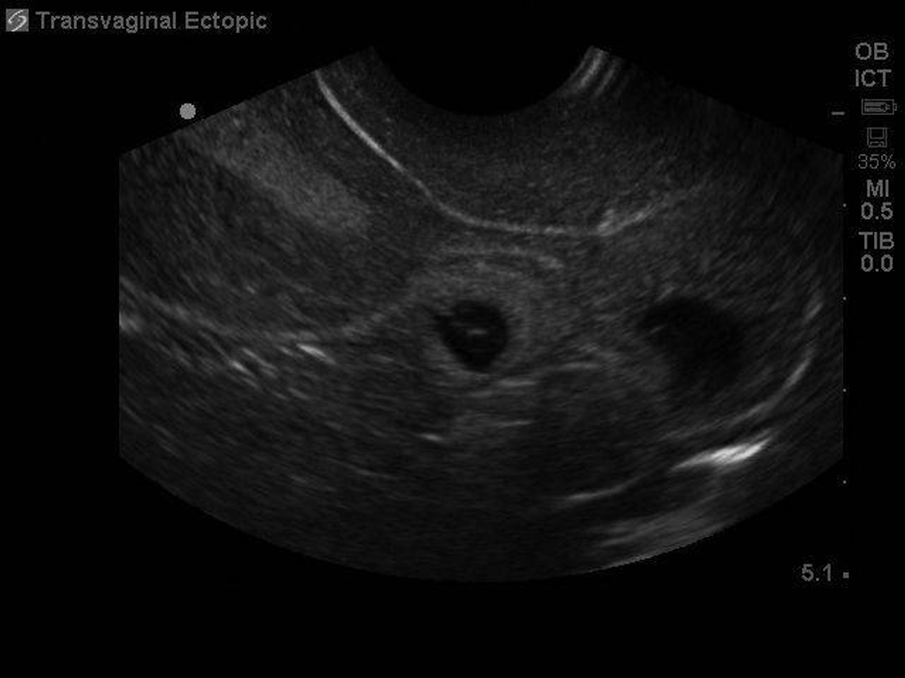 Ectopic Pregnancy Transvaginal Ultrasound Training Model
