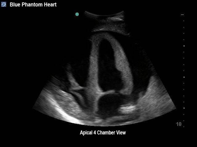 Transthoracic Echocardiography and Pericardiocentesis Ultrasound Training Model