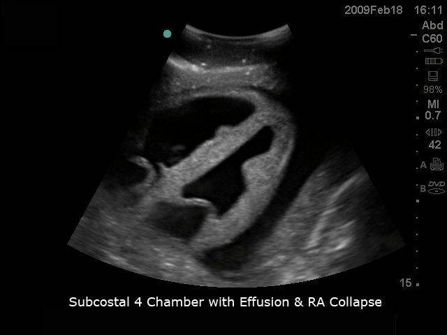 Transthoracic Echocardiography and Pericardiocentesis Ultrasound Training Model