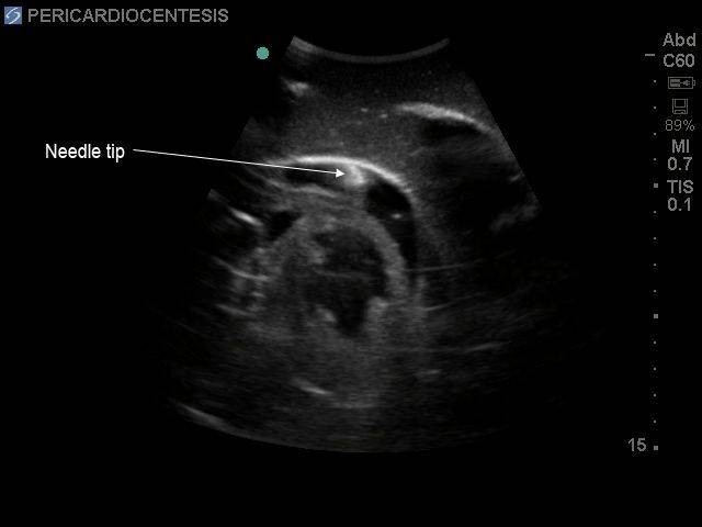 Transthoracic Echocardiography and Pericardiocentesis Ultrasound Training Model