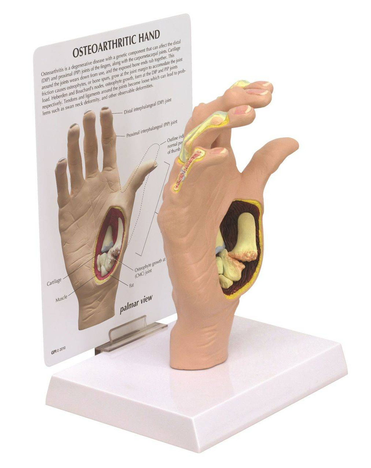 Osteoarthritis Hand Anatomy Model