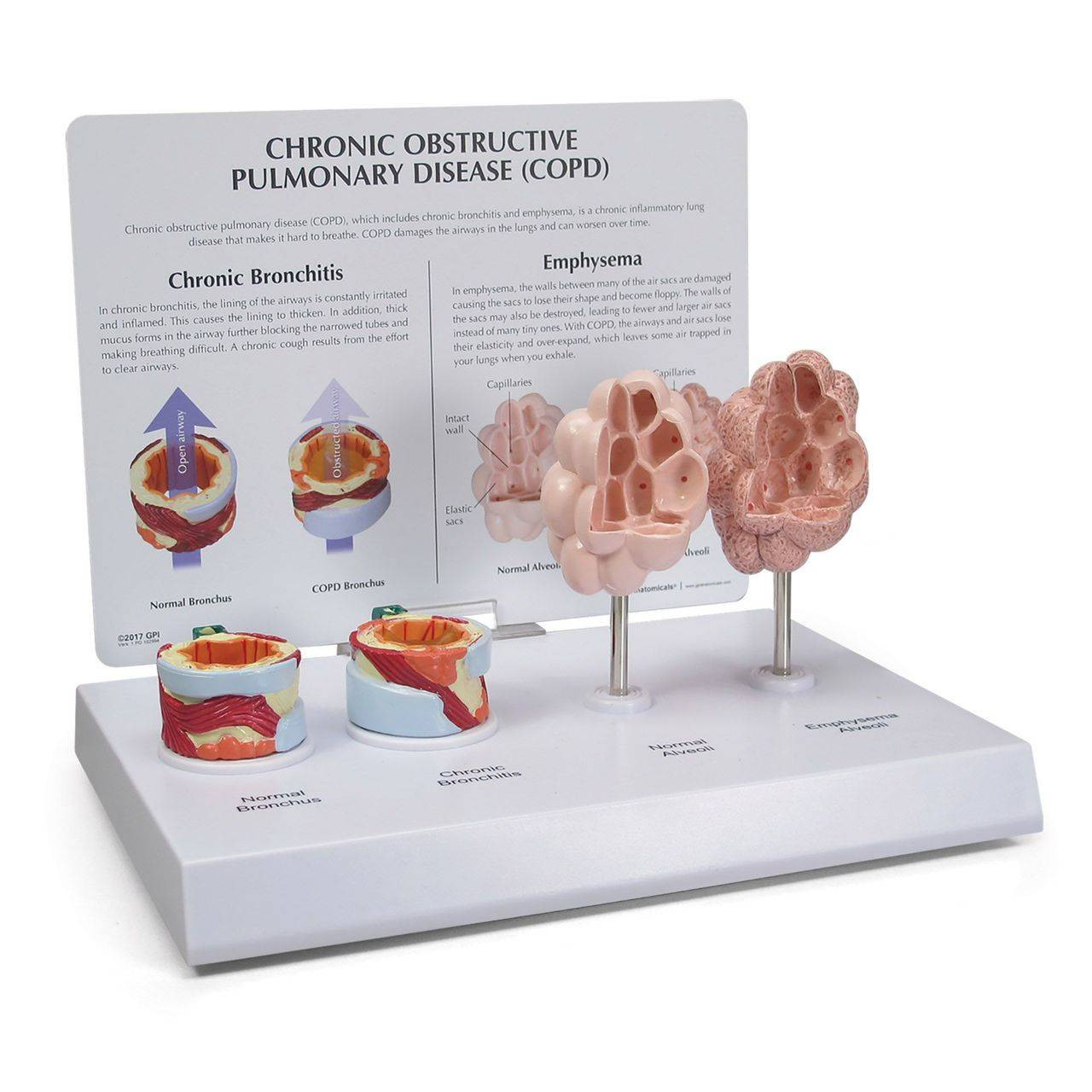 COPD Model with Bronchus and Alveoli