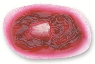 Compound Fracture Of The Humerus Bone Stick-On