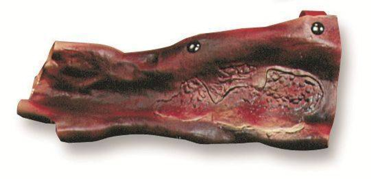 Burn Of The Forearm Model 2nd and 3rd Degree