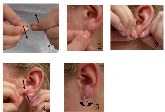 MEDICAL EAR PIERCING